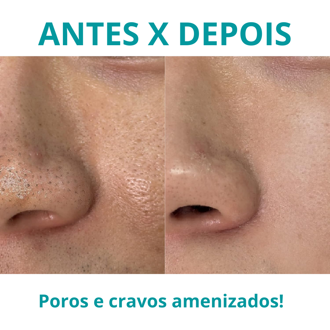 BoosterSkin Pro - Aparelho Facial Coreano